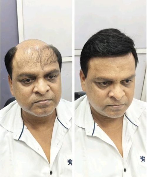 Hair Patch service at Hercovits Hair Studio